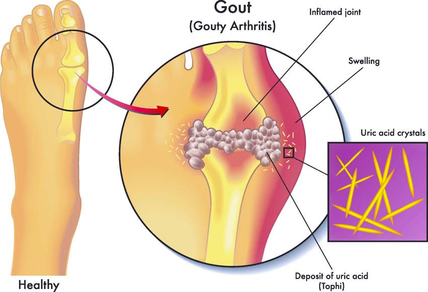 gout arthritis treatment